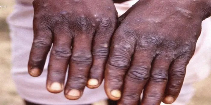 What’s in a name? Why giving monkeypox a new one is a good idea